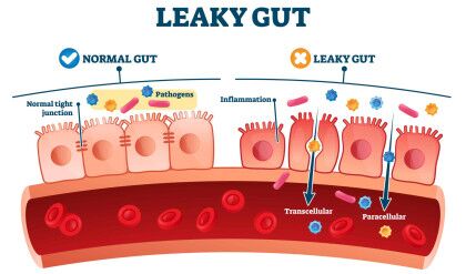 Leaky,Gut,Syndrome,As,Medical,Chronic,Inflammation,Condition,Explanation.,Labeled